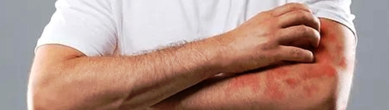 Psoriasis & Eczema Treatment Center By H2|Dermatology's cover image